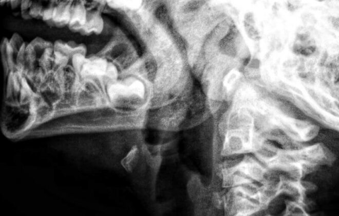 Imagen de una radiografía de cuello.