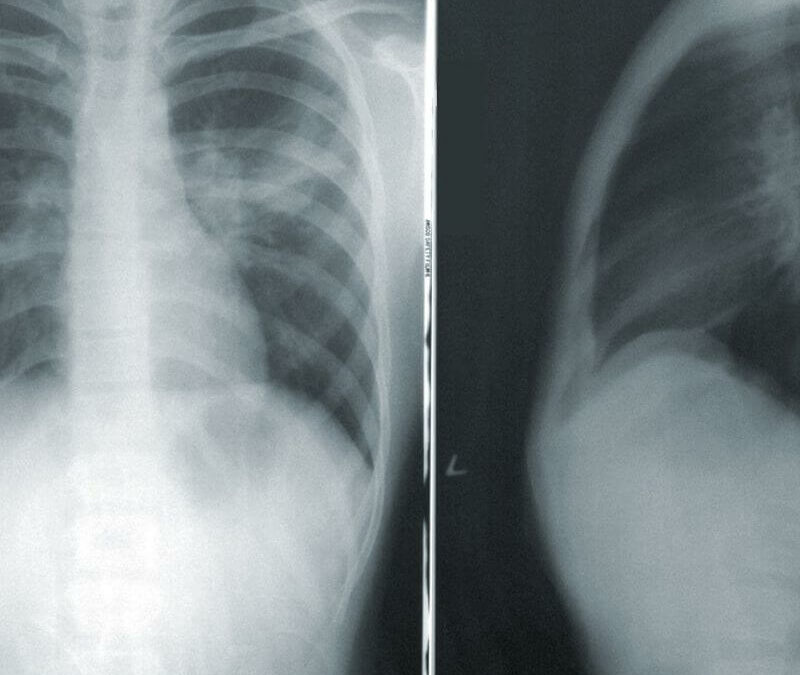 Un ejemplo de radiografía abdominal.