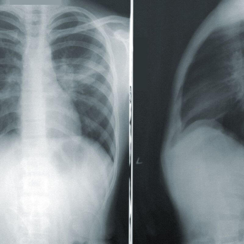 Un ejemplo de radiografía abdominal.