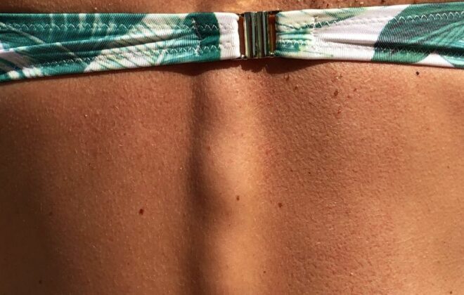 Lipoma: causas, síntomas y tratamiento.